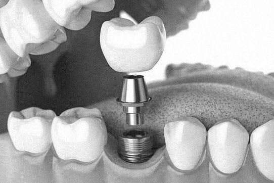 Implantes dentales en Sevilla