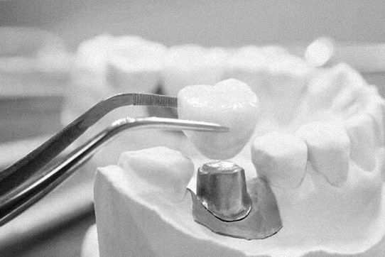 Prótesis dental fija Sevilla